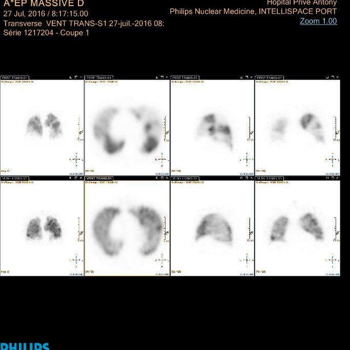 Scintigraphie pulmonaire