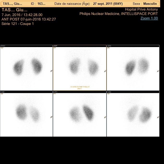 Scintigraphie statique au DMSA